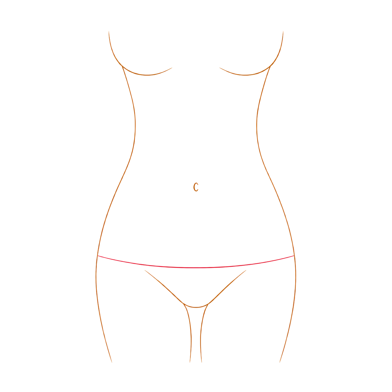 Diagram showing the incision pattern for a lower body lift