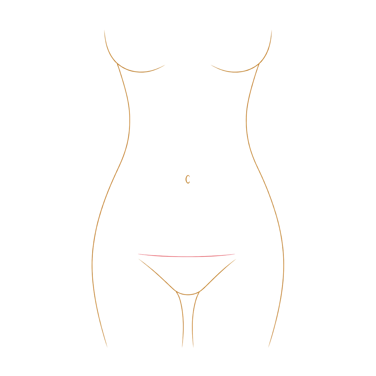Diagram showing the incision pattern for a mini abdominoplasty