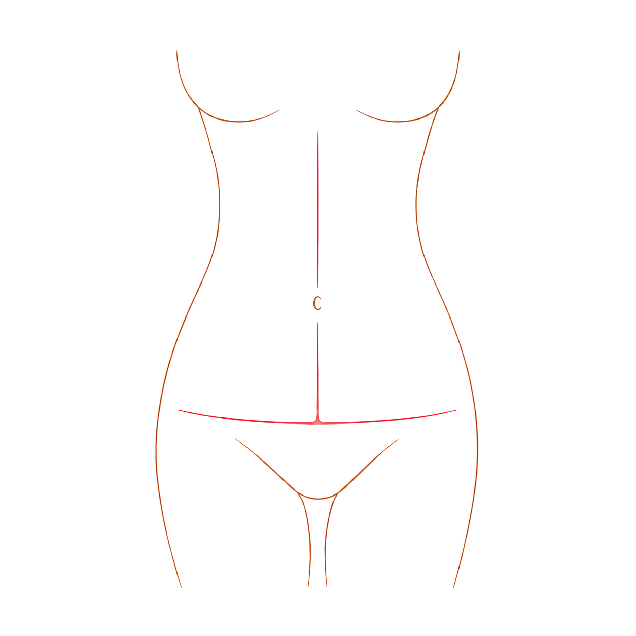 Diagram showing the incision pattern for a Fleur-de-lis abdominoplasty