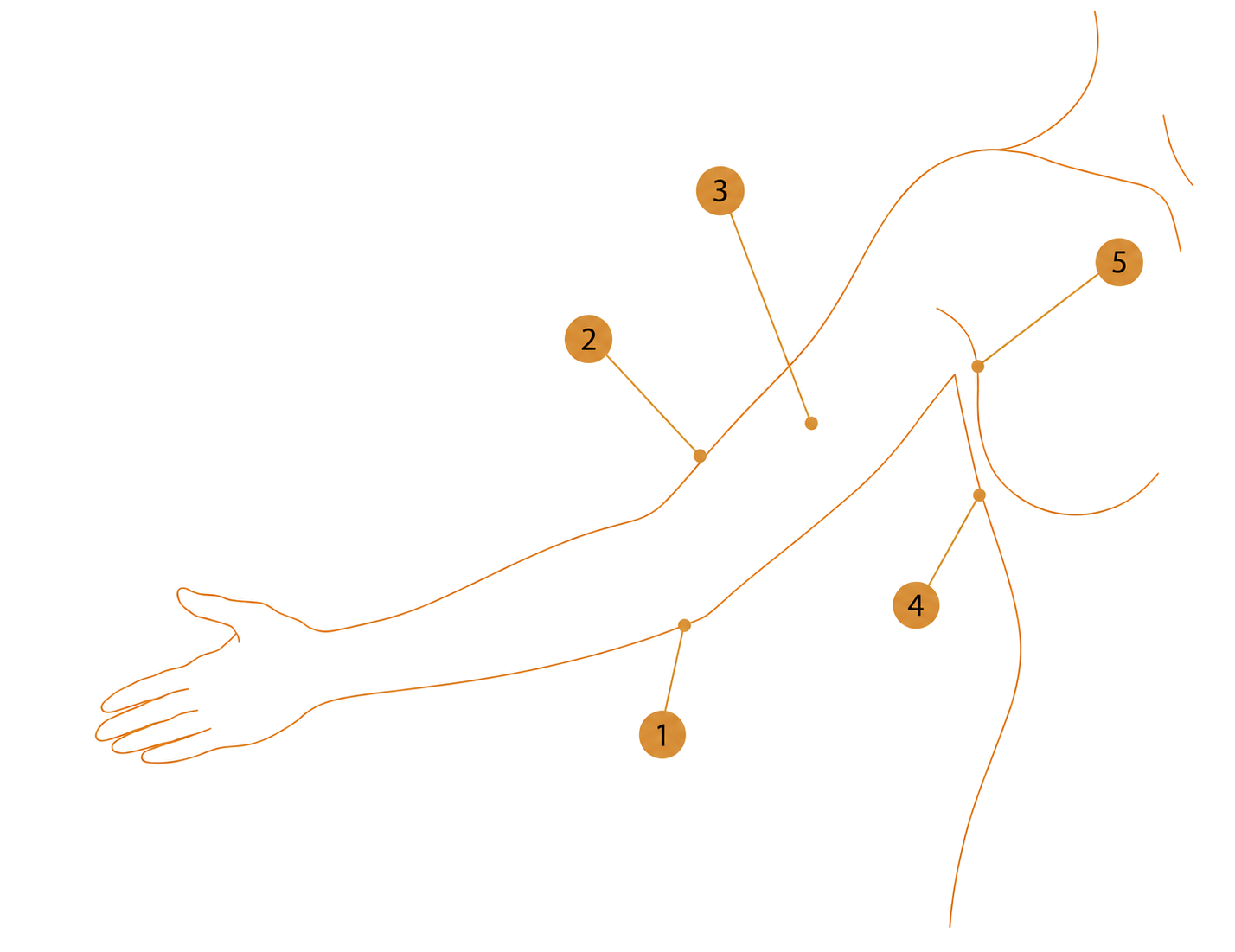 Diagram showing areas that may be improved with an arm lift