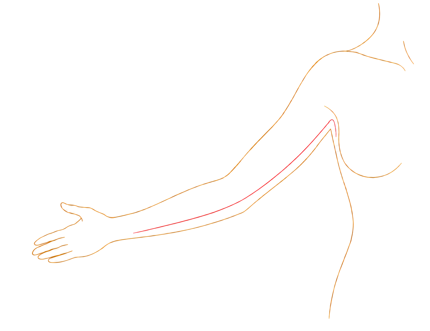 Diagram showing an extended arm-lift scar continuing into the armpit and adjacent areas