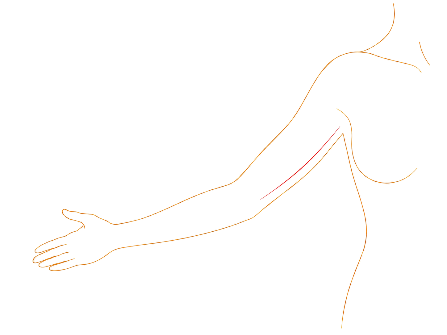 Schema zur Narbenführung bei einer Oberarmstraffung