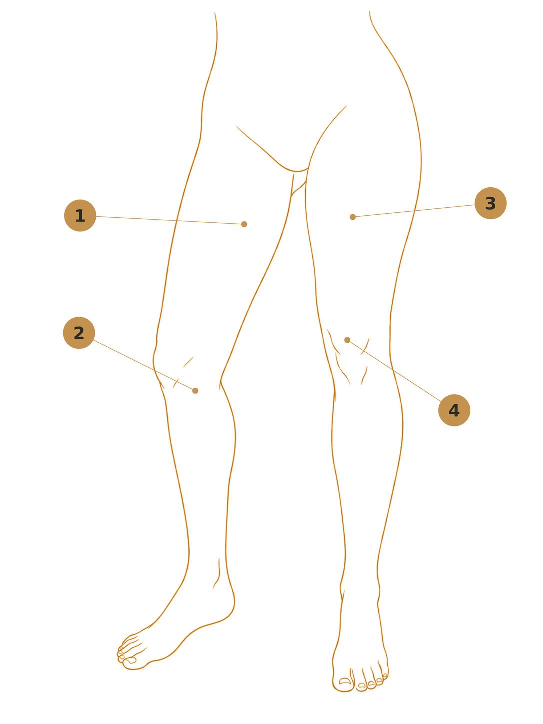 Diagram showing areas that may be improved with a thigh lift