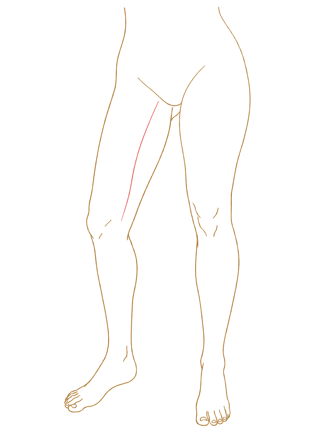 Diagram showing the inner-leg scar pattern for a vertical thigh lift